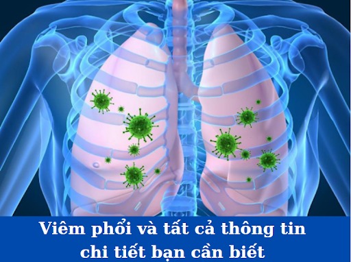 Viêm phổi và tất cả thông tin chi tiết bạn cần biết